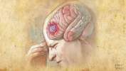 علائم تومور مغزی: تشخیص و درمان تومور مغزی