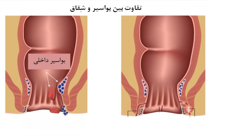 تفاوت بین بواسیر و شقاق مقعد چیست؟