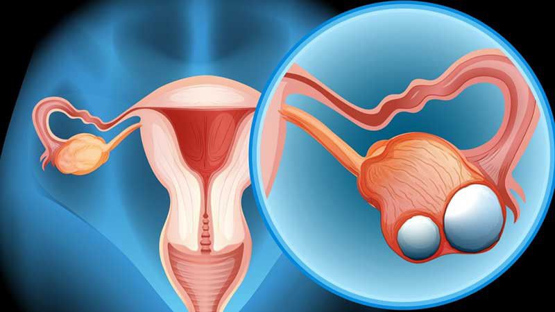 سرطان تخمدان علل، علائم و درمان