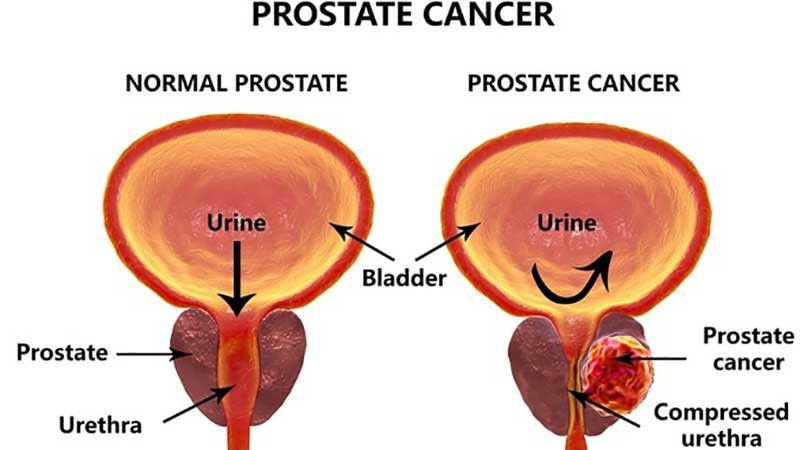 سرطان پروستات، علائم و درمان