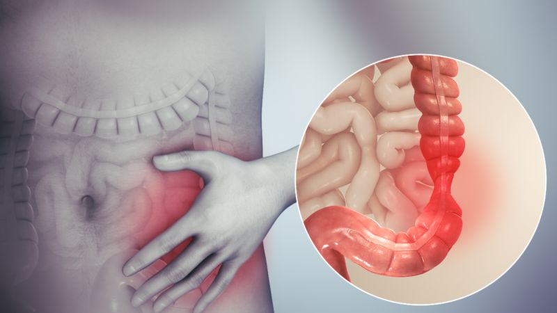 سندرم روده تحریک پذیر یا آی بی اس (IBS)