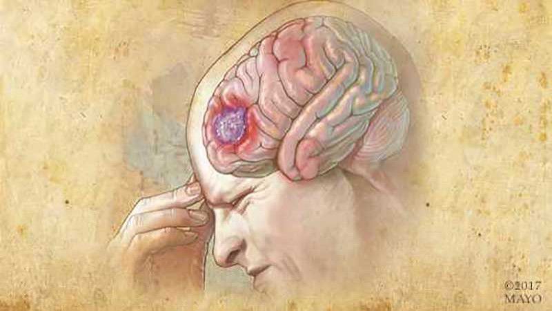 علائم تومور مغزی: تشخیص و درمان تومور مغزی