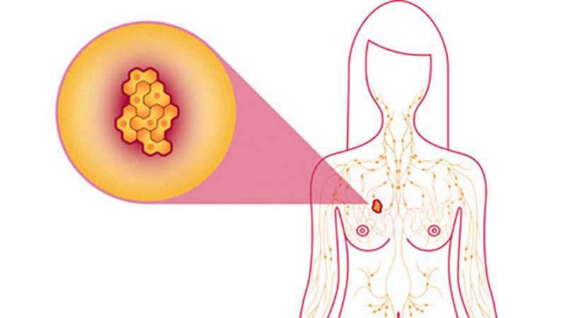 انواع بیماریهای التهابی پستان